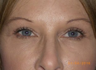 Patient 114 - After View 