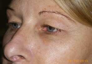 Female Eyelid Surgery