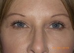 Upper and Lower Eyelid Blepharoplasty with Laser Resurfacing