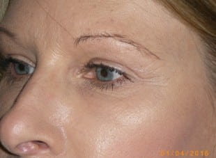 Patient 37 - After View 