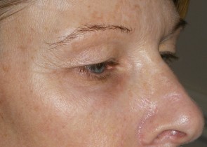 Upper and Lower Eyelid Blepharoplasty with Laser Resurfacing