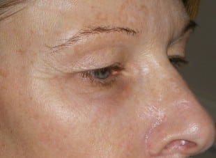 Patient 37 - Before View 