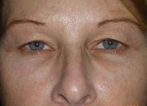 Upper and Lower Eyelid Blepharoplasty with Laser Resurfacing