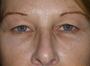 Patient 37 - Before View 