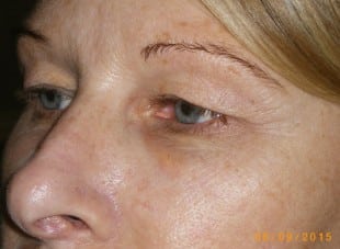 Patient 37 - Before View 