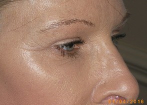 Upper and Lower Eyelid Blepharoplasty with Laser Resurfacing