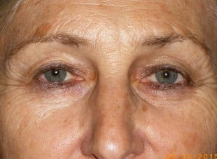 Patient 126 - Before View 