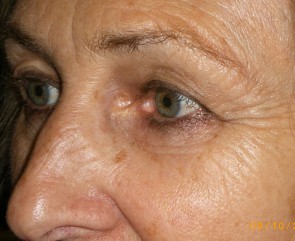 Female Eyelid Surgery