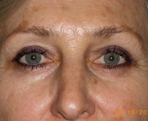 Female Eyelid Surgery