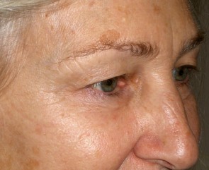 Female Eyelid Surgery