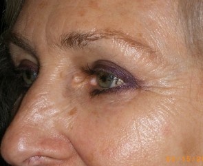 Female Eyelid Surgery