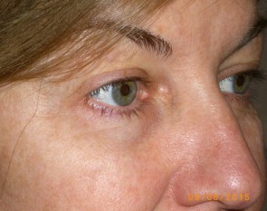 Female Eyelid Surgery