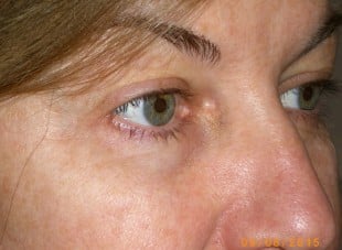 Patient 128 - Before View 