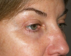 Female Eyelid Surgery