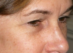 Patient 107 - Before View 