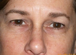 Patient 107 - Before View 