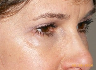 Patient 107 - After View 