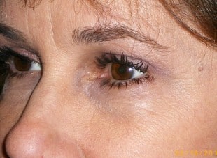 Patient 107 - After View 