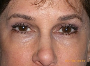 Patient 107 - After View 