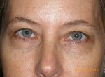 Female Eyelid Surgery