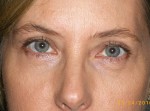 Female Eyelid Surgery