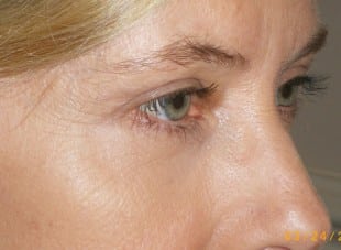 Patient 112 - After View 