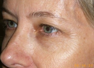 Patient 112 - Before View 