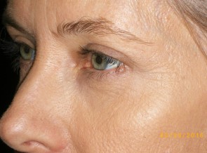 Female Eyelid Surgery