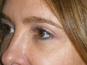 Female Eyelid Surgery