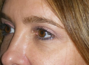 Patient 75 - After View 