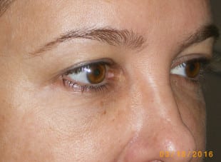 Patient 75 - Before View 