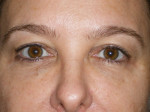 Female Eyelid Surgery