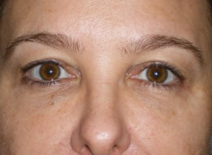 Patient 75 - Before View 