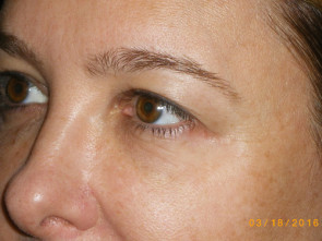 Female Eyelid Surgery