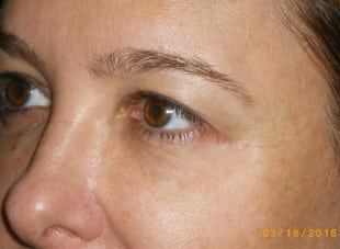 Patient 75 - Before View 