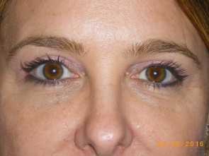 Female Eyelid Surgery