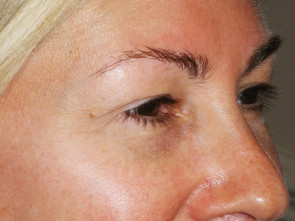 Female Eyelid Surgery