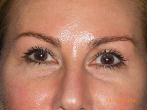 Female Eyelid Surgery