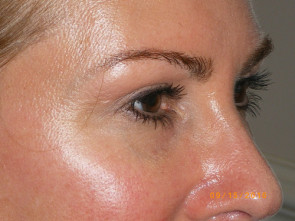 Female Eyelid Surgery