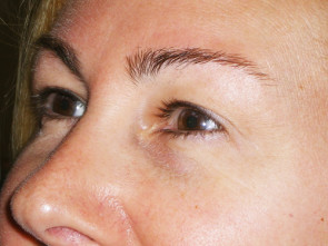 Female Eyelid Surgery