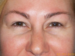 Female Eyelid Surgery