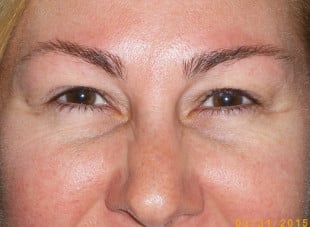 Patient 86 - Before View 