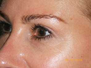 Female Eyelid Surgery