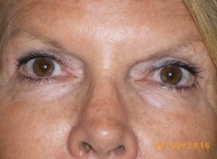Patient 96 - After View 