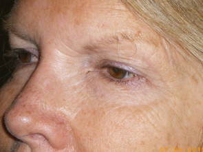 Female Eyelid Surgery