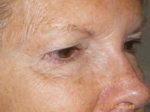 Female Eyelid Surgery