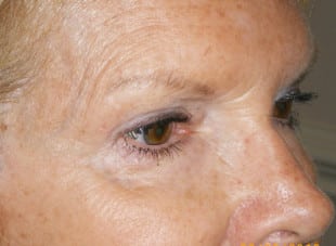 Patient 96 - After View 