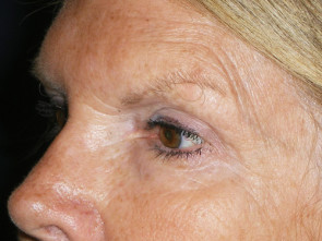 Female Eyelid Surgery