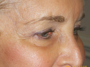 Female Eyelid Surgery