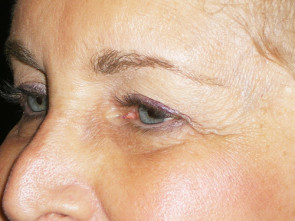 Female Eyelid Surgery